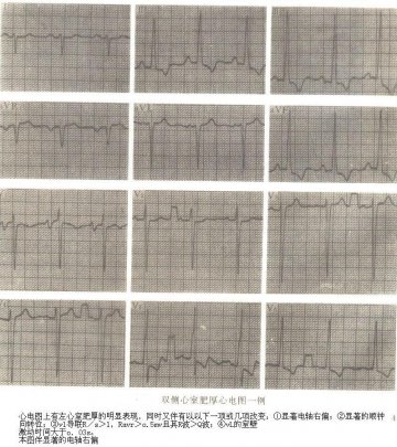 双侧心窒肥厚
