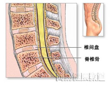 椎间盘突出骨移植修补术
