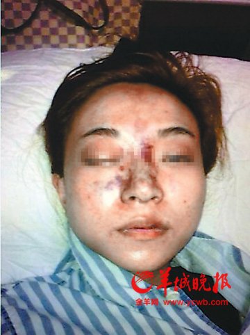 佛山一80后女孩隆鼻致右眼失明 国外医院难医治