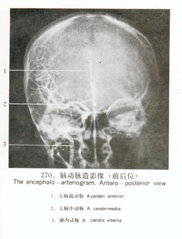 脑动脉造影像（前后位）