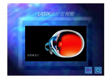 lasik4
