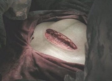 人体探秘：实拍剖腹产震撼生产过程