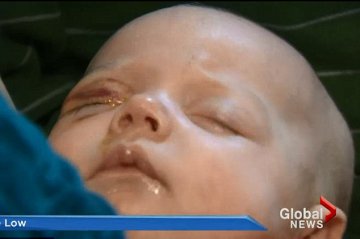 加拿大同卵三胞胎均患罕见眼球癌