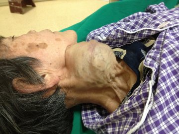 临床快递：老中医颈部巨瘤疯长8年瘤体血管细密如蚯蚓紧抱