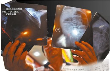 婴儿被诊断需做10万元手术续：医院称系杜撰