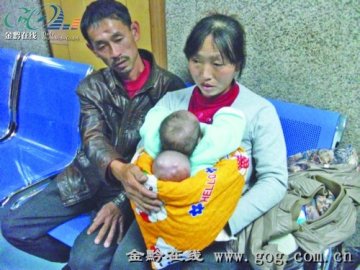 新生儿患“脑膜膨出”一个身子两个“头”