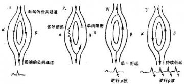 阵发性心动过速