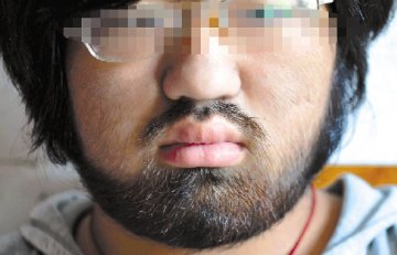 16岁女孩因药物副作用得多毛症满脸络腮胡