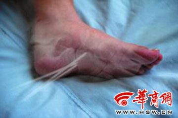 患者右脚骨裂左脚被动手术 院长称纯属误会