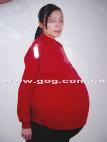产子后肚子越长越大 91斤巨瘤困扰女子12年