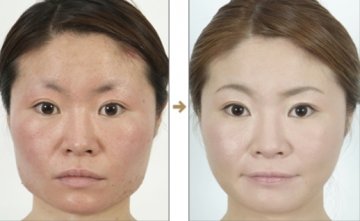 日本整形医院惊悚整容对比照大曝光