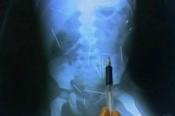 瞠目结舌X光片：女人下体都能放点儿啥