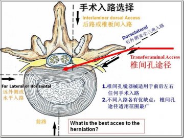 空军总医院椎间孔镜技术治腰痛