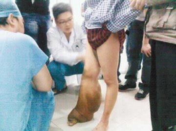 少女小腿粗如“象腿” 抬脚行走如拖一袋面