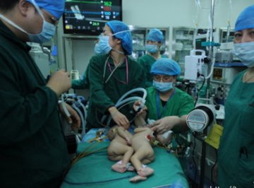 永州联体女婴在湖南省儿童医院成功分离