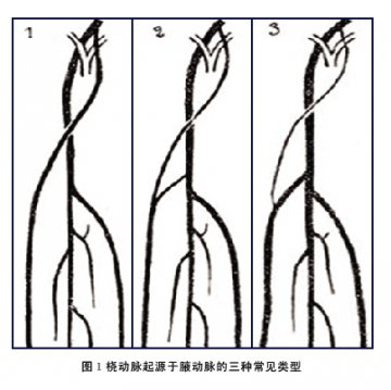 桡动脉入路的解剖变异及处理