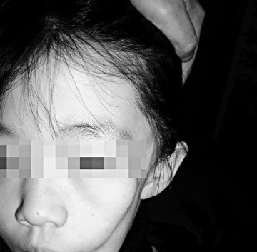 山西长治11岁女孩左脸部肌肉塌陷病因难寻