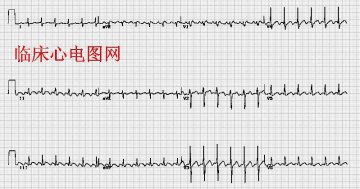 心房扑动2：1传导Atrial flutter with 2：1 AV conduction