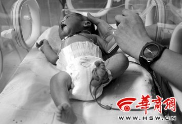 腹腔所孕胎儿平安降生 几率为15000分之一