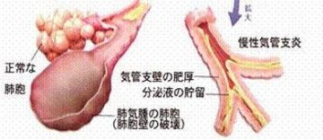 301医院：肺病死亡率高应及时预防和治疗