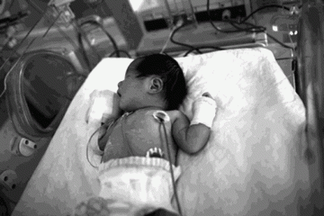 手套箍坏新生婴儿小手