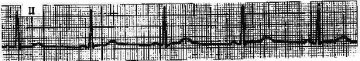 窦性心动过缓 Sinus bradychycardia