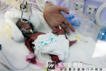 孕期26周男婴体重480克 脑袋仅网球大小