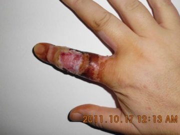 网上售药号称一喷就好 患者使用后溃烂流脓