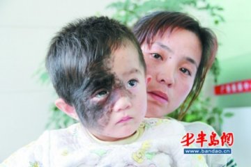 山东女娃患怪病 有脸长出黑斑毛发似