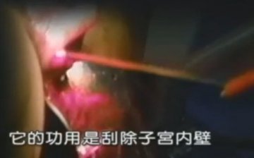 实拍：美国堕胎手术全过程
