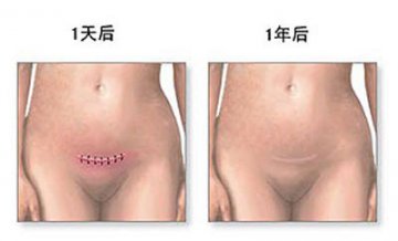 女性剖腹产手术全过程图解