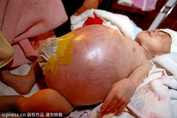 5个月男婴得怪病肚如气球