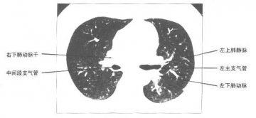 正常胸部肺窗CT（3）