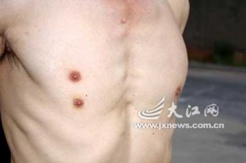 奇！中年男子身上长有三个乳头