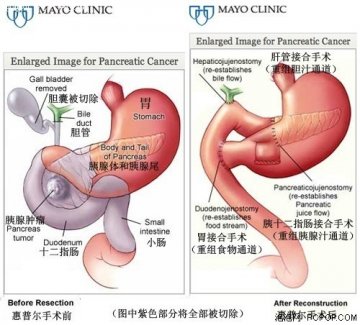 揭秘胰腺癌 乔布斯与胰腺癌的八年抗战史
