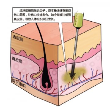 女子整容失败致下巴长成“脚后跟”
