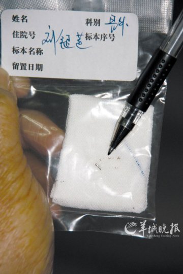 男子术后6年发现异物 为打官司开刀取“针头”