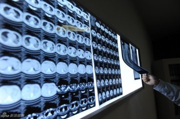 4、医护人员在查看H7N9禽流感患者肺部CT及胸片