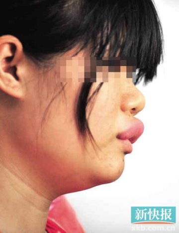 女子15年前吃了狗肉 嘴唇长成“香肠”？