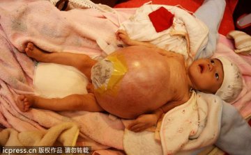 5个月男婴得怪病肚如气球