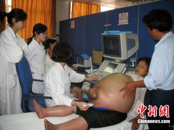 湖南一妇女肚子直径1.5米 疑似卵巢肿瘤