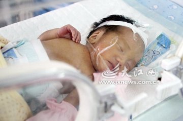 19岁产妇生三胞胎女婴 坚强母亲自然分娩