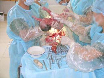 实拍剖腹产全过程
