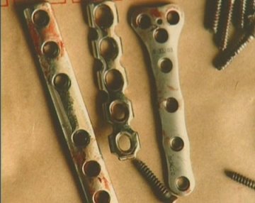 医院违规购进钢板 患者植入体内后久治不愈