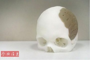 3D打印成功用于颅骨移植