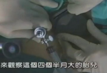 实拍：美国堕胎手术全过程