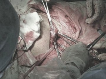 人体探秘：实拍剖腹产震撼生产过程