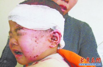 两岁男童栽进滚烫粥锅里多处被烫伤