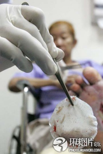 全球最不可思议的“治病”怪招 泰国用蛆治病