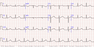 先天性QT间期延长综合征Long QT syndrome